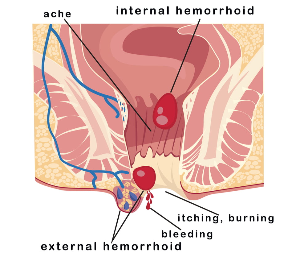Natural Hemorrhoids Treatment: How to Treat Hemorrhoids