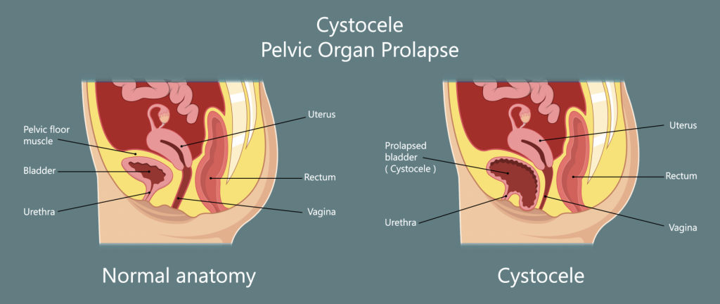 Cystocele is when the bladder drops into the vagina often resulting in urinary incontinence.