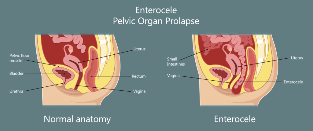 Enterocele is when the small intestine bulges into the vagina.