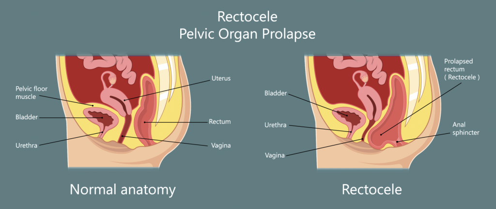 Rectocele is when the rectum bulges into the vagina.