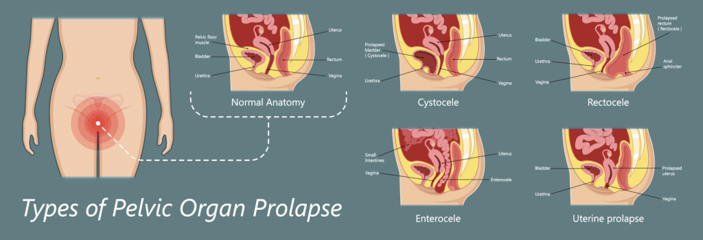 Different Types of Pelvic Organ Prolapse
