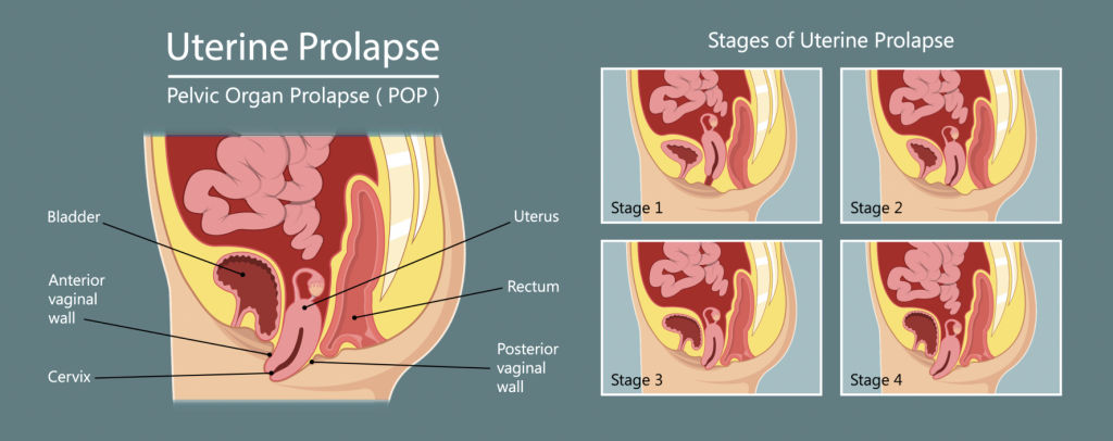 Uterine Prolapse is when the uterus drops down or protrudes out the vagina.