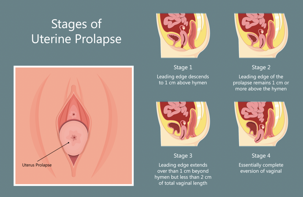 There's a significant indicator for every Stage of Uterine Prolapse you should know for awareness.