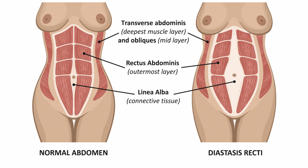 Diastasis recti is the separation of the abdominal wall that is at least 2 fingers wide.