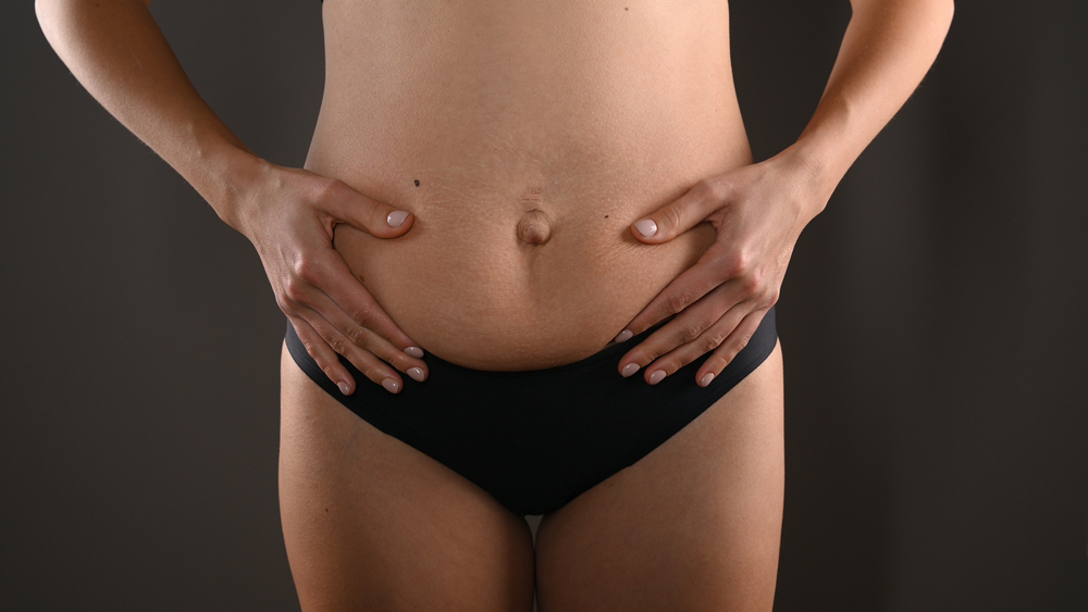 How to tell the difference between Diastasis recti and Hernia.