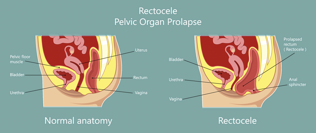 Rectocele is also known as herniated rectum, or prolapsed rectum.