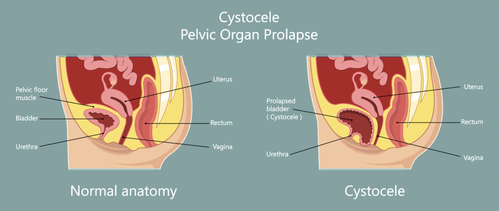 Cystocele is also known as prolapsed, herniated, or dropped bladder.
